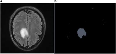 A novel approach to brain tumor detection using K-Means++, SGLDM, ResNet50, and synthetic data augmentation